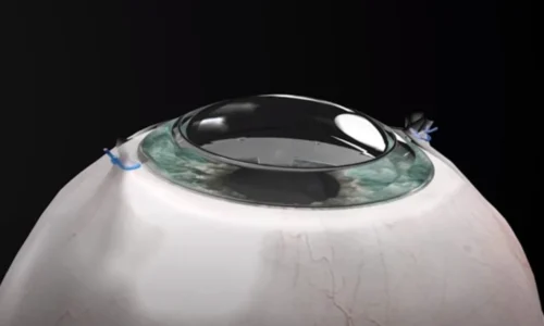 Israel cria córnea sintética que faz cegos recuperarem a visão