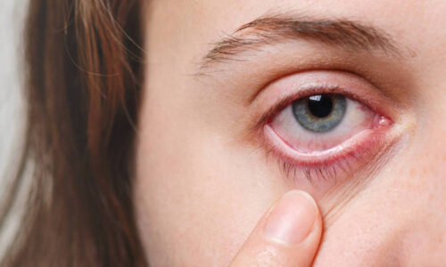 Abril Marrom: alerta sobre doenças que podem levar à cegueira