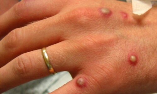 “Não tem por que ela não chegar ao Brasil’, diz virologista sobre a varíola do macaco