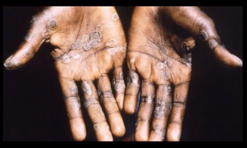 CIDADE DE MS REGISTRA 1º CASO SUSPEITO DE VARÍOLA DOS MACACOS