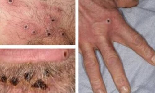 Em um mês, varíola do macaco é detectada em mais de 30 países, no maior surto já visto fora da África